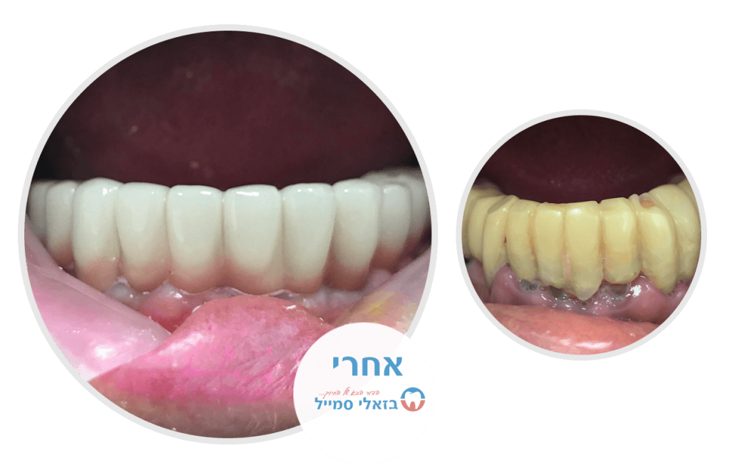 שיקום הפה לסת תחתונה