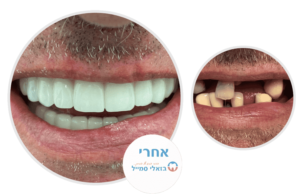 שיקום הפה לסת עליונה