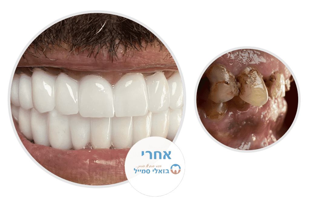 השתלות שיניים בכל הפה