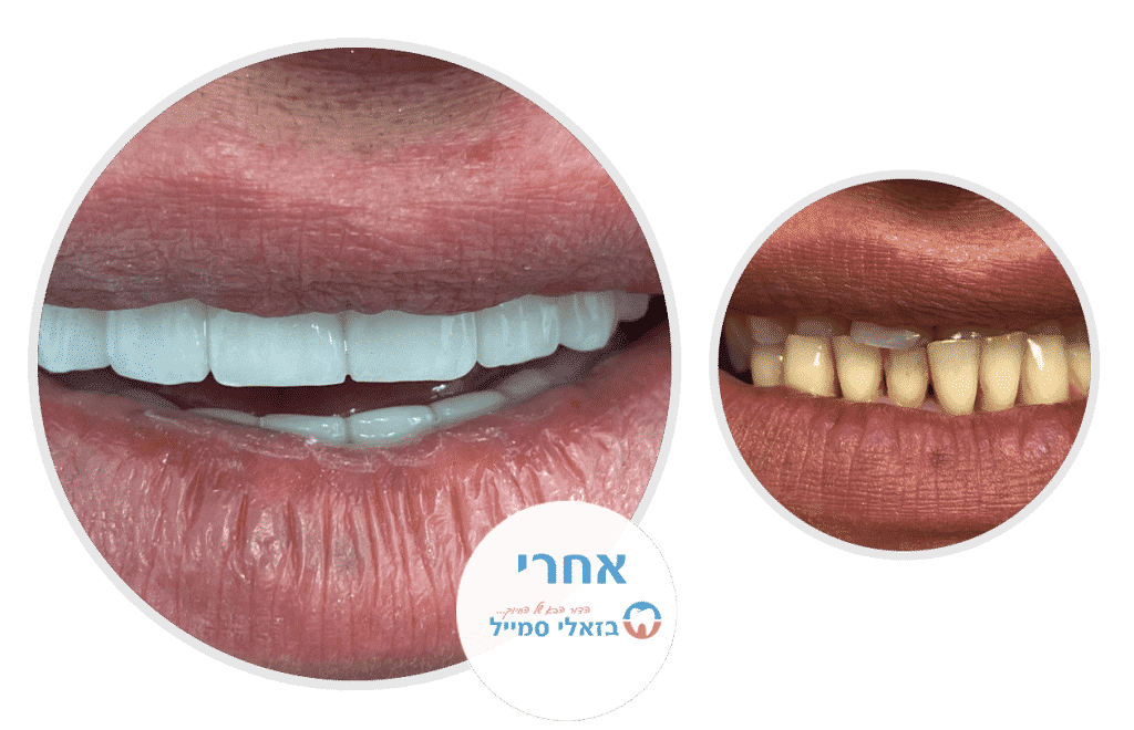 שיקום לסת עליונה